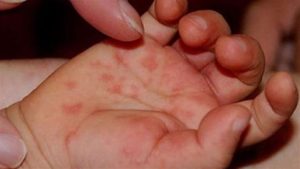 В Мариуполе 30 новых случаев кори, среди заболевших – двое младенцев